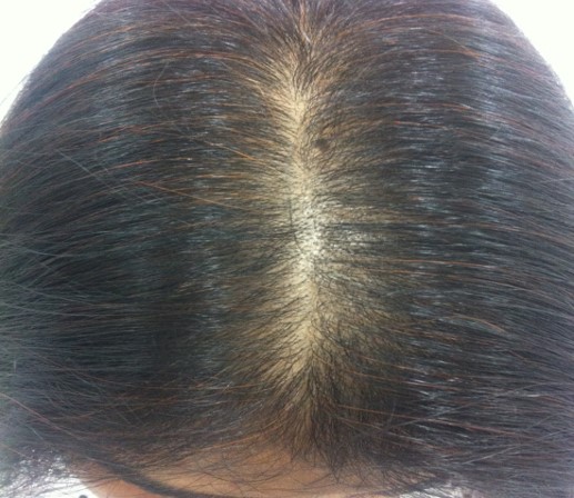 Hair loss treatment Before - Shalani @olivaclinic