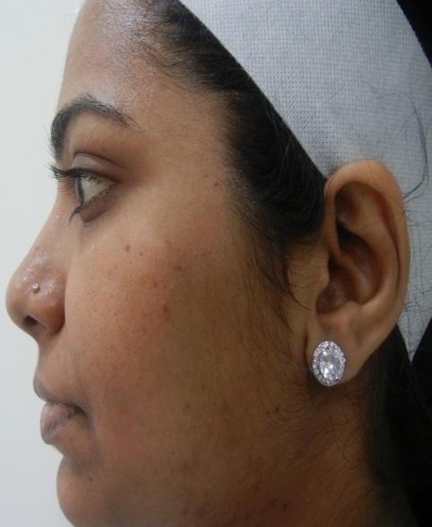 Skin lightening treatment Before - Sravani @olivaclinic