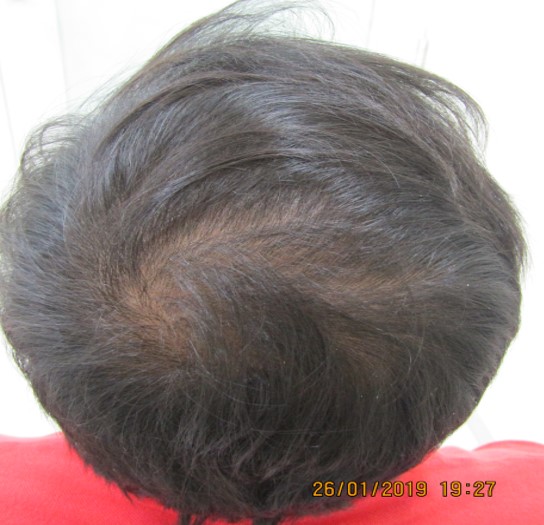 Hair loss treatment After - Surya @olivaclinic