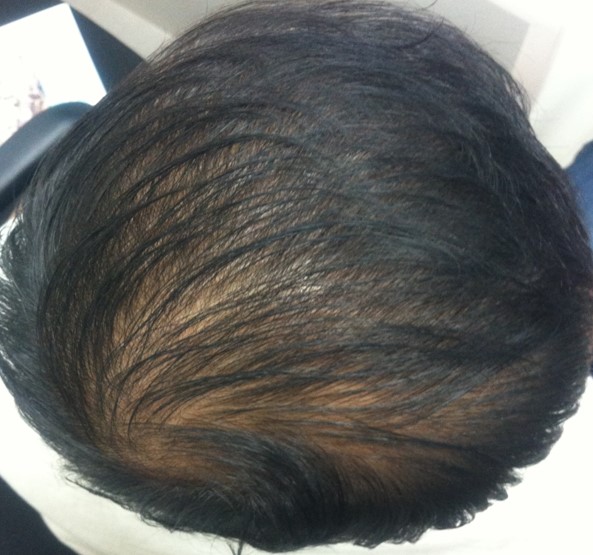 Hair loss treatment Before - Surya @olivaclinic