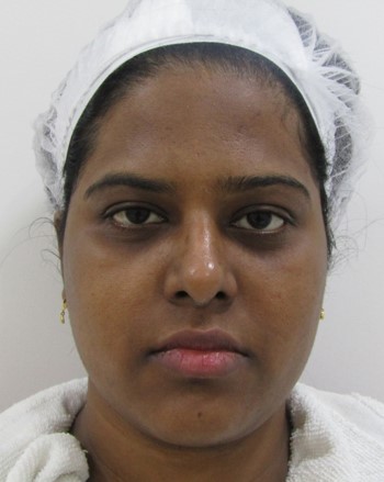 Skin lightening treatment Before - Venkata @olivaclinic