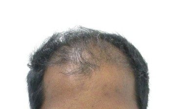 Hair loss treatment Before - Vijay @olivaclinic