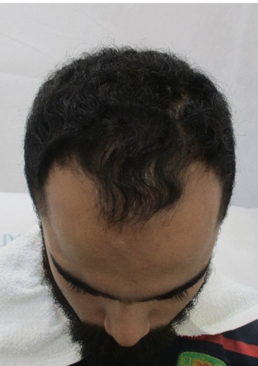 Hair loss treatment Before - Vishwas @olivaclinic