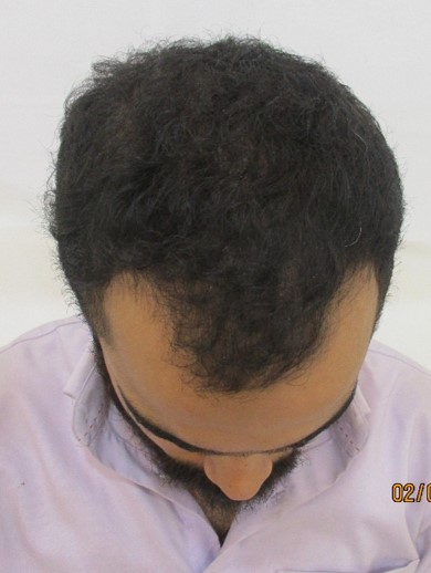 Hair loss treatment After - Vishwas @olivaclinic