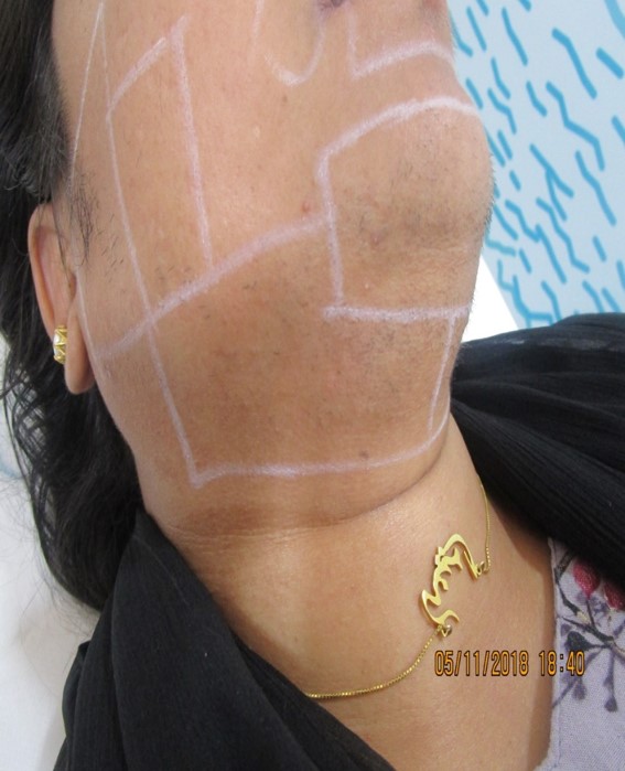 laser hair removal for chin After treatment - Ameena @olivaclinic
