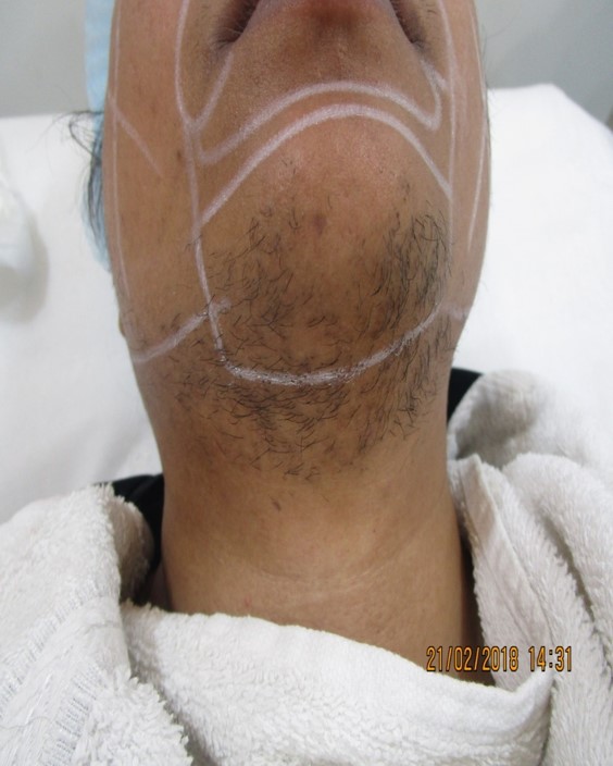 laser hair removal for chin Before treatment - Ameena @olivaclinic