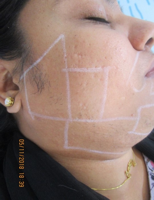 laser hair removal sideburns After treatment - Ameena @olivaclinic