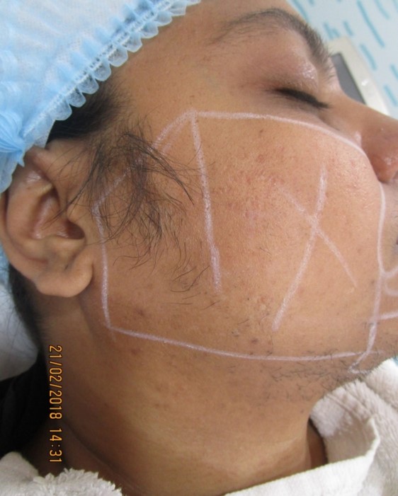 laser hair removal sideburns Before treatment - Ameena @olivaclinic