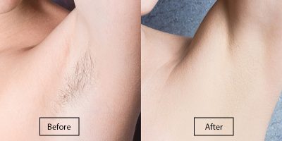 Laser Underarm Hair Removal