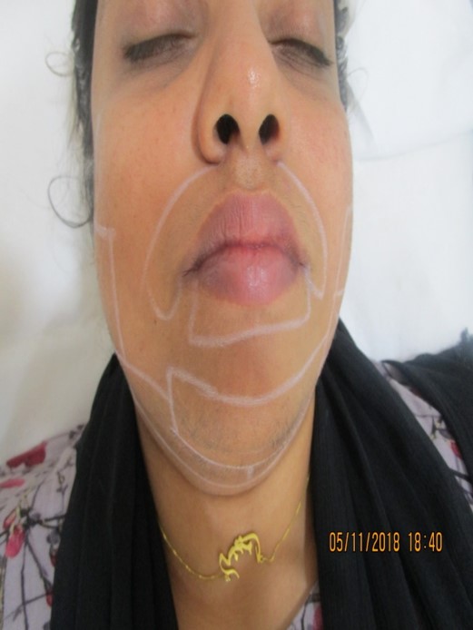 upper lip laser hair removal After treatment - Ameena @olivaclinic