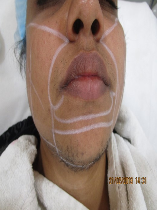 upper lip laser hair removal Before treatment - Ameena @olivaclinic