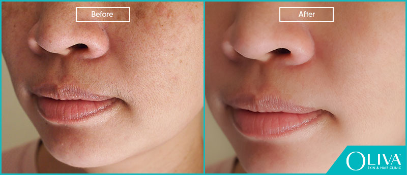 Chemical peels from a dermatologist
