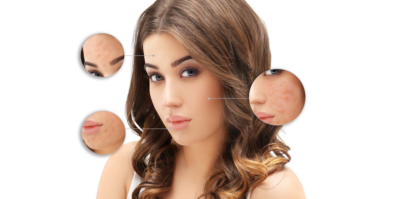 pimple acne scar removal kolkata