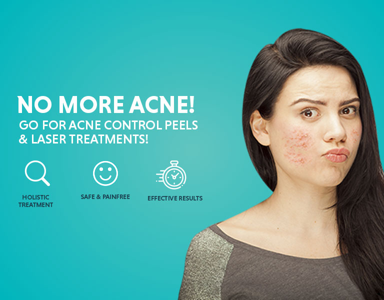 Acne Vulgaris Causes, Symptoms And Treatment