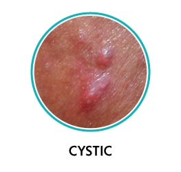 cystic acne vulgaris