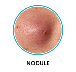 nodular acne vulgaris