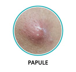 papules acne