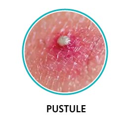 pustules acne