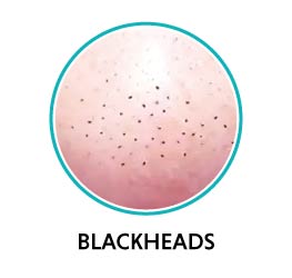 blackheads on nose