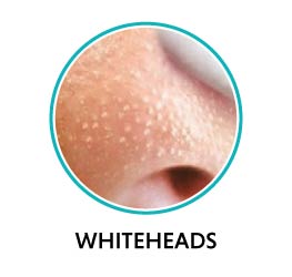 whitehead acne on nose