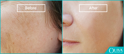 resurfacing fractional