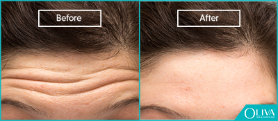 skin resurfacing for forehead lines