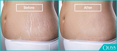 skin resurfacing for pregnancy stretch marks