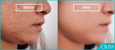 skin resurfacing for face