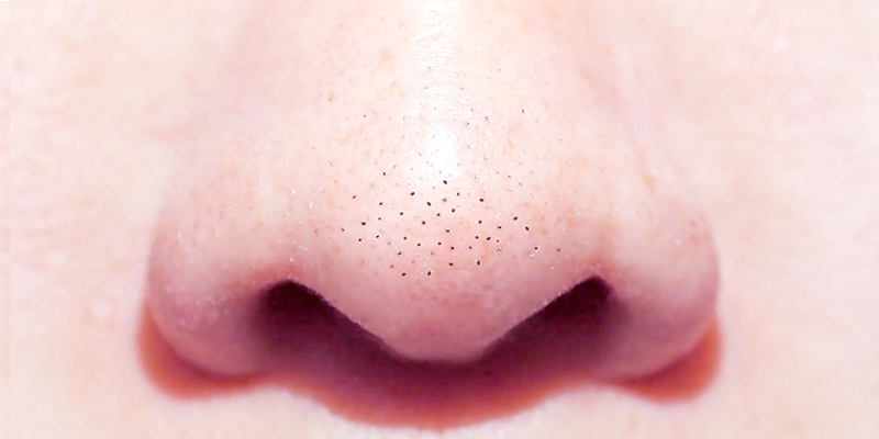 Blackheads On Nose: Removal Treatments, Cost And Results