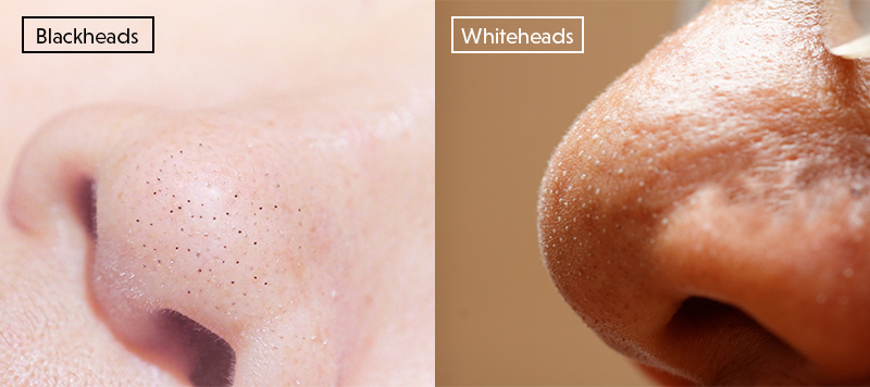 blackheads vs whiteheads