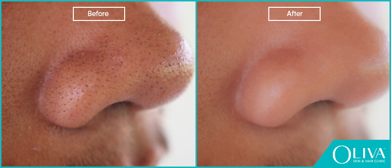 build modnes buket Blackheads On Nose: Removal Treatments, Cost And Results