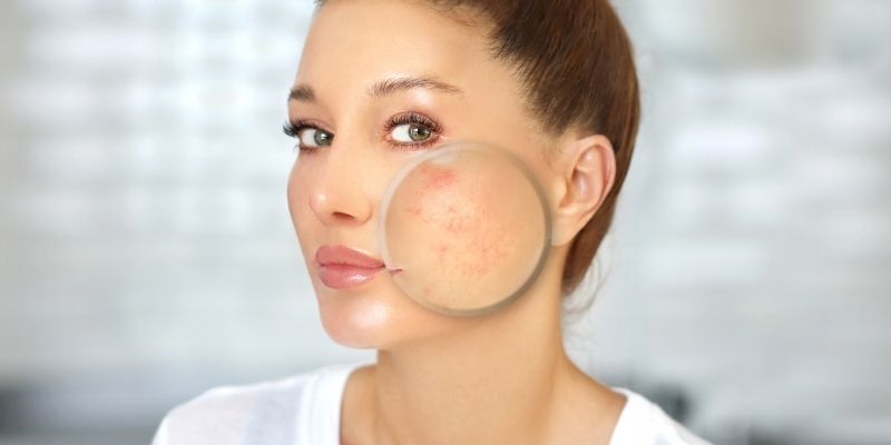 Prescription Adult Acne Treatments