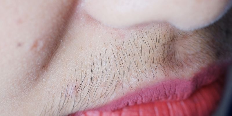 hirsutism treatment