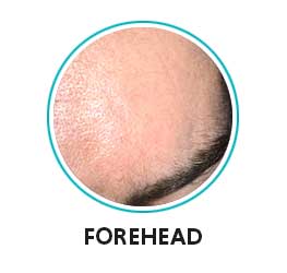 open pores on forehead 