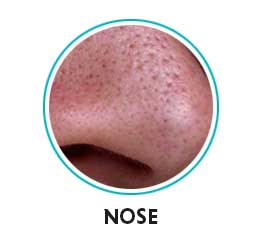 open pores on nose