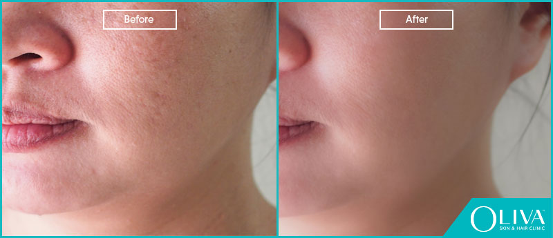 open pores on face before and after results