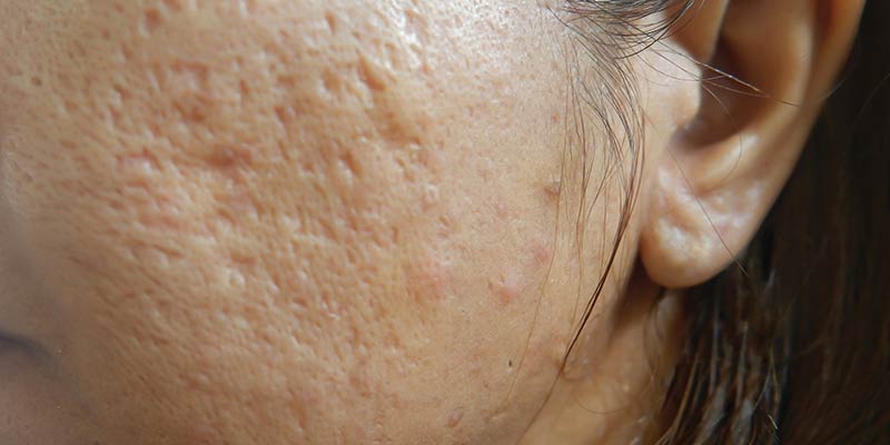 How to Get Rid of Pitted Acne Scars: Expert Tips and Tricks