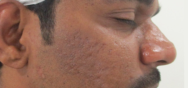 acne scar treatment before-2[1]