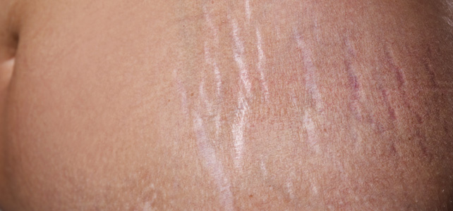before and after results of stretch marks treatment