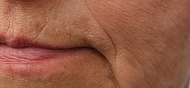 before image of skin tightening treatment
