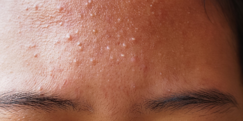Forehead Acne (Pimple): Causes, Treatments, Prevention, And Results