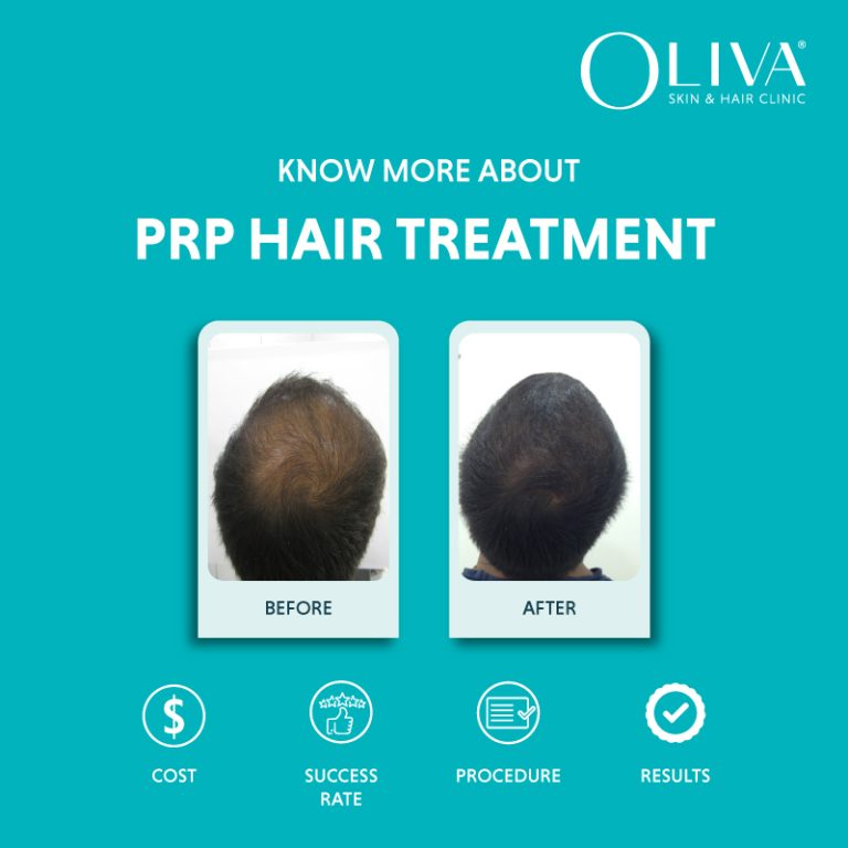 PRP Hair Treatment