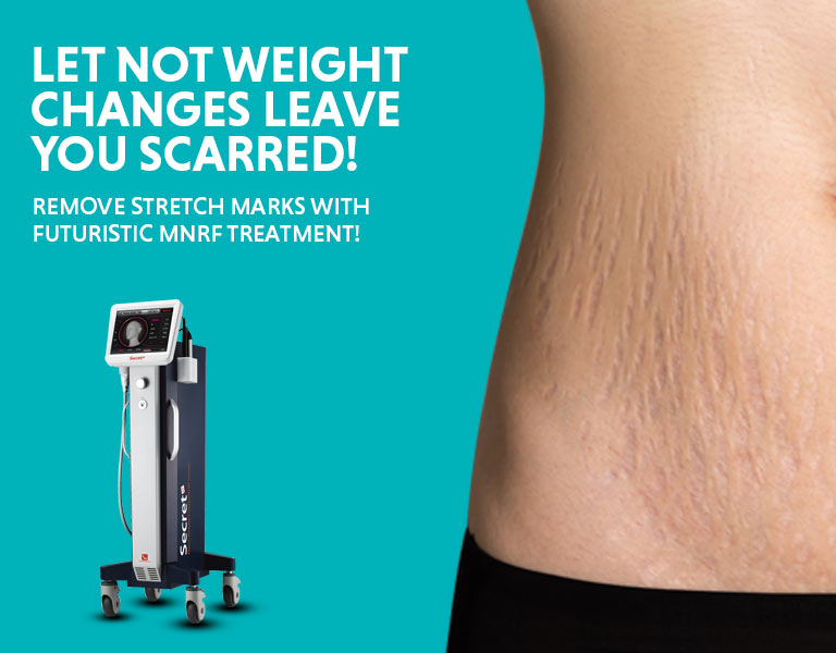 Stretch-Marks