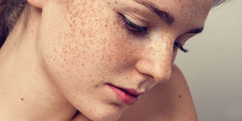 freckles treatment