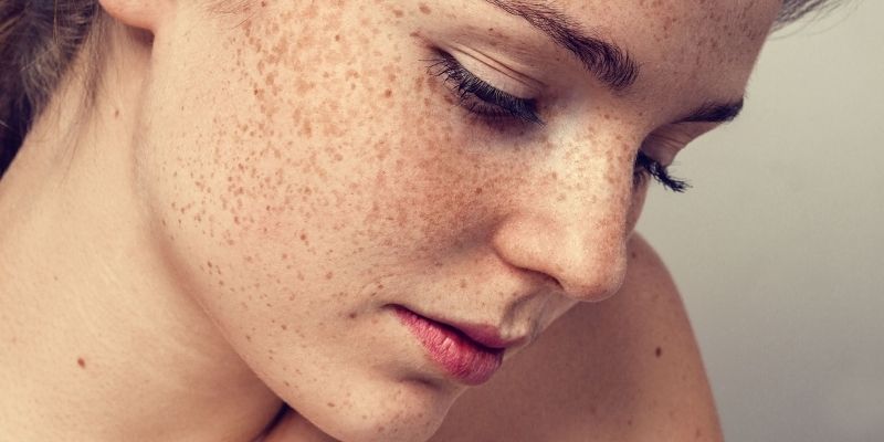 What's The Difference Between Freckles And Sun Spots?: Center Aesthetic &  Dermatology