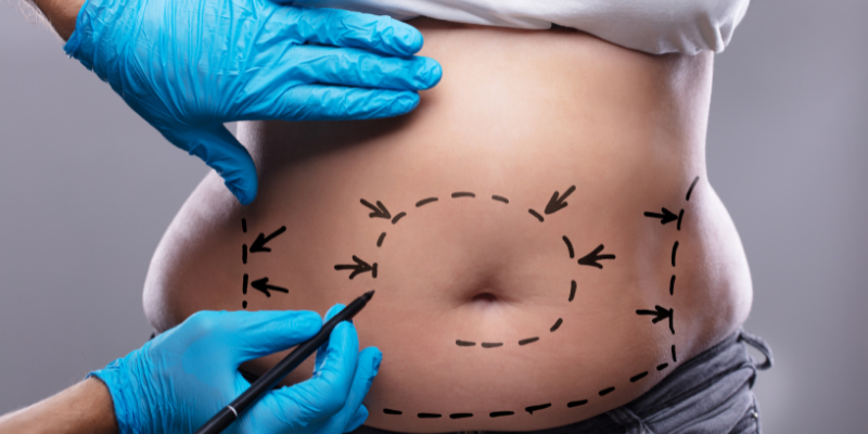 liposuction