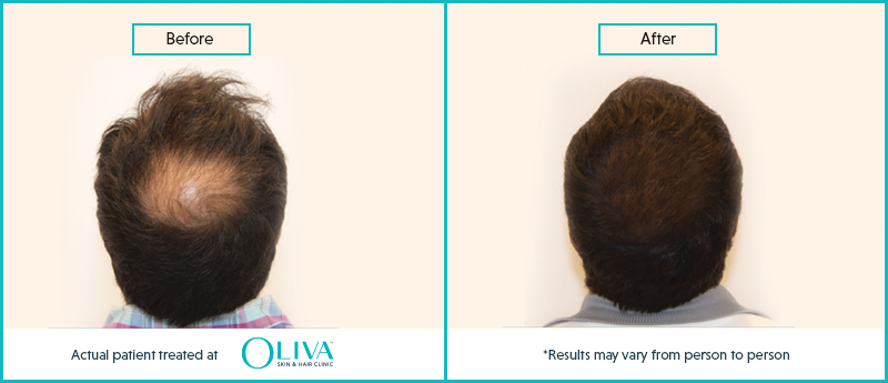 PRP Hair Treatment In Chennai: Cost, Results & Procedure