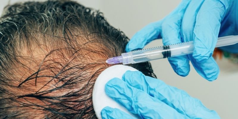 PRP Treatment in Ahmedabad Best PRP Hair Loss Treatment In India