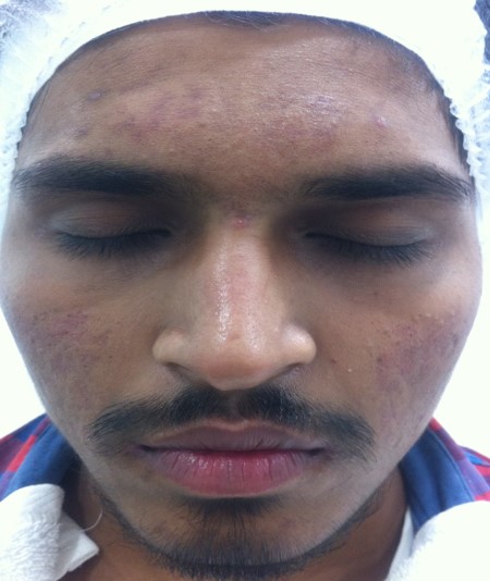 Acne treatment After - Madhav @olivaclinic