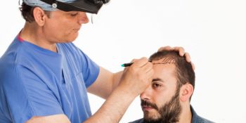 fue hair transplant